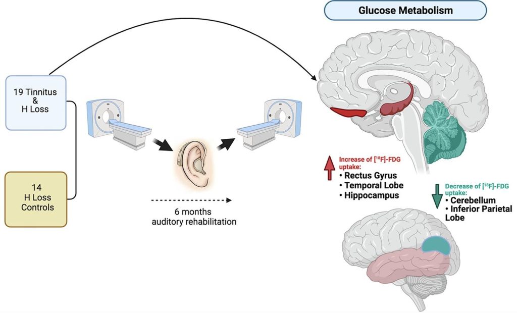 A graphical abstract mapping a positron emission tomography (PET) brain imaging study evaluating the efficacy of hearing aids for tinnitus therapy. Under the participants section, a flowchart shows two groups: 19 individuals with tinnitus and hearing loss, and 14 individuals with hearing loss serving as controls. An arrow indicates a 6-month period of auditory rehabilitation. Under the results section, a diagram highlights regional changes in glucose metabolism following rehabilitation, showing an increase in uptake in the rectus gyrus, temporal lobe, and hippocampus, alongside a decrease in uptake in the cerebellum and inferior parietal lobe.